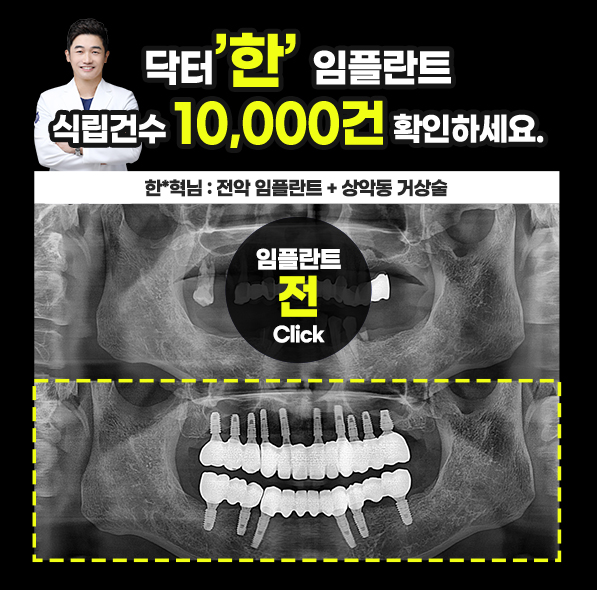 닥터한 임플란트 사례②