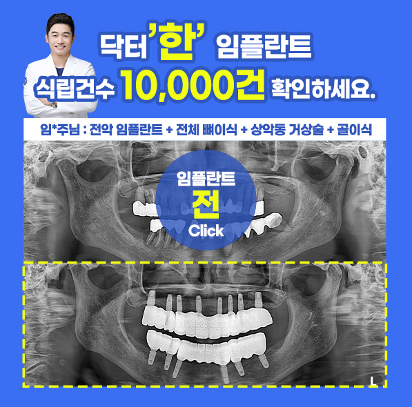 닥터한 임플란트 사례③