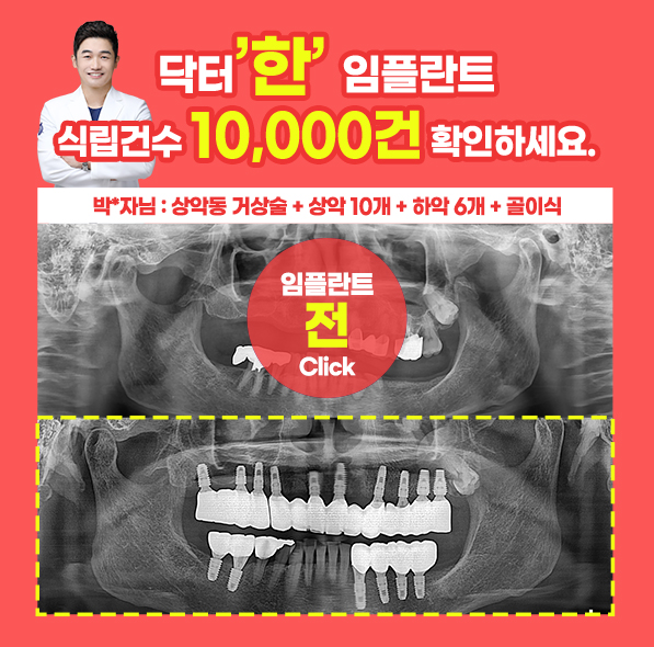닥터한 임플란트 사례④