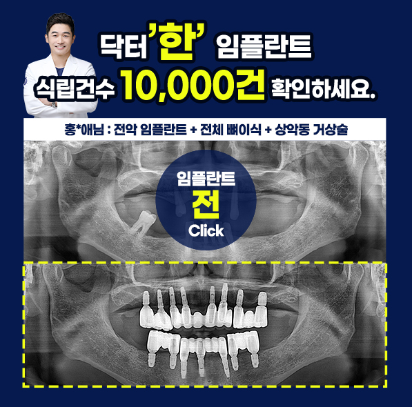 닥터한 임플란트 사례④