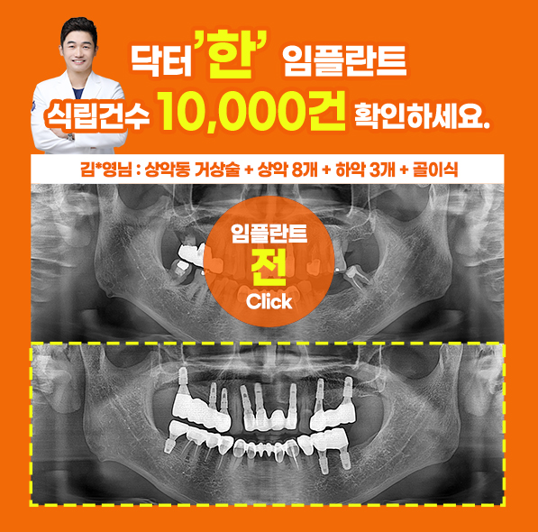 닥터한 임플란트 사례⑥